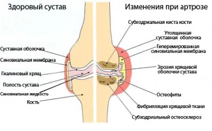 Деформуючий артроз причини, симптоми, лікування традиційне і народне (лікування) Деформуючий артроз причини, симптоми, лікування традиційне і народне