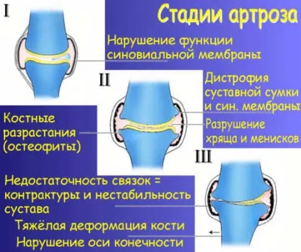 Деформуючий артроз причини, симптоми, лікування традиційне і народне (деформуючий) Деформуючий артроз причини, симптоми, лікування традиційне і народне