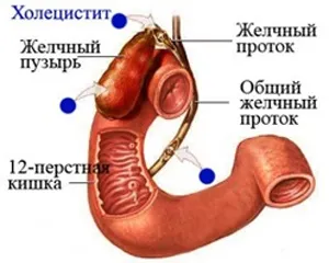 Холецистит у дітей - причини, симптоми і лікування