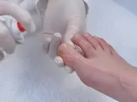Ефективне лікування грибка нігтів (нігтів) Ефективне лікування грибка нігтів