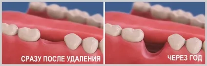 Якщо ви втратили зуб, найімовірніше, ви можете втратити наступний, стоматологічна клініка (поставити імплант) Якщо ви втратили зуб, найімовірніше, ви можете втратити наступний, стоматологічна клініка