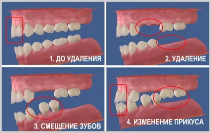 Якщо ви втратили зуб, найімовірніше, ви можете втратити наступний, стоматологічна клініка (імплантація зубів ціна + в Одессае) Якщо ви втратили зуб, найімовірніше, ви можете втратити наступний, стоматологічна клініка