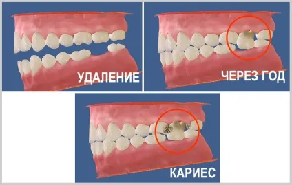 Якщо ви втратили зуб, найімовірніше, ви можете втратити наступний, стоматологічна клініка (протезування зубів) Якщо ви втратили зуб, найімовірніше, ви можете втратити наступний, стоматологічна клініка