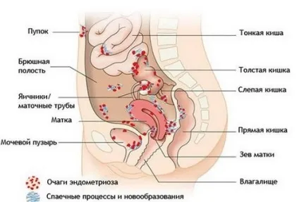 Ендометріоз кишечника причини, ознаки, симптоми і лікування (ендометріоз) Ендометріоз кишечника причини, ознаки, симптоми і лікування