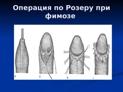 Фімоз що робити якщо голівка не відкривається, причини і лікування звуження крайньої плоті (фімоз) Фімоз що робити якщо голівка не відкривається, причини і лікування звуження крайньої плоті