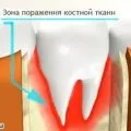 Флюороз зубів, лікування (лікування) Флюороз зубів, лікування