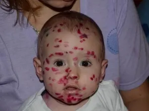 Фукорцин склад і лікарські форми, показання та протипоказання до застосування (фукорцин) Фукорцин склад і лікарські форми, показання та протипоказання до застосування