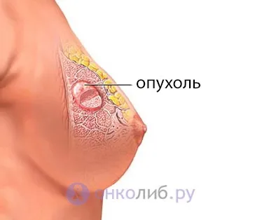 Гамартома легких, гіпоталамуса - лікування, симптоми (лікування) Гамартома легких, гіпоталамуса - лікування, симптоми