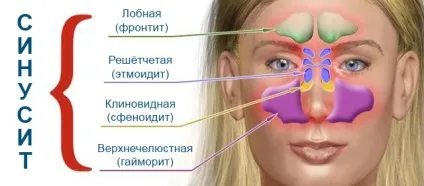 Гайморит і синусит - в чому різниця і чим вони відрізняються (гайморит) Гайморит і синусит - в чому різниця і чим вони відрізняються