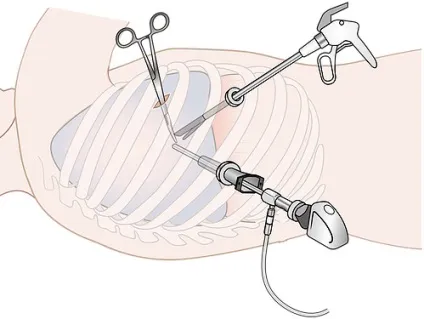 Гамартома легких, гіпоталамуса - лікування, симптоми (лікування) Гамартома легких, гіпоталамуса - лікування, симптоми