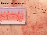 Гіперемія шкіри обличчя і шкірних покривів тіла причини, лікування