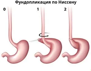 ГЕРБ хірургічне лікування, опис способів операцій (способів) ГЕРБ хірургічне лікування, опис способів операцій