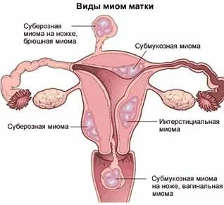 Гінекологія в Москві недорого, консультація цілодобово (болі області таза) Гінекологія в Москві недорого, консультація цілодобово