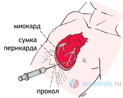 Гідроперикард причини, лікування, у дорослих, плода (гидроперикард) Гідроперикард причини, лікування, у дорослих, плода