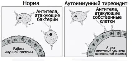 Гіпертиреоз волосся «змушує» робитися жорсткими і рівномірно випадають (гіпертиреоз) Гіпертиреоз волосся «змушує» робитися жорсткими і рівномірно випадають