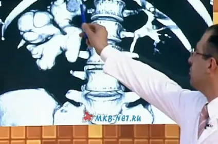 Гідронефроз лівої нирки - симптоми і лікування (лівої) Гідронефроз лівої нирки - симптоми і лікування