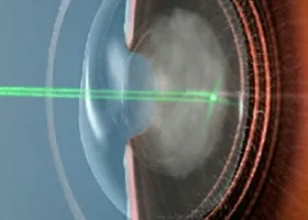 ІАГ-лазерна капсулотомія - офтальмологічний центр ophthalmica (дісцізія задньої капсули) ІАГ-лазерна капсулотомія - офтальмологічний центр ophthalmica