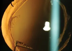 ІАГ-лазерна капсулотомія - офтальмологічний центр ophthalmica (провідний офтальмологічний центр Салонік) ІАГ-лазерна капсулотомія - офтальмологічний центр ophthalmica