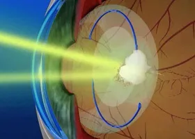 ІАГ-лазерна капсулотомія - офтальмологічний центр ophthalmica (ІАГ-лазерна) ІАГ-лазерна капсулотомія - офтальмологічний центр ophthalmica