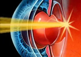 ІАГ-лазерна капсулотомія - офтальмологічний центр ophthalmica (провідний офтальмологічний центр Салонік) ІАГ-лазерна капсулотомія - офтальмологічний центр ophthalmica