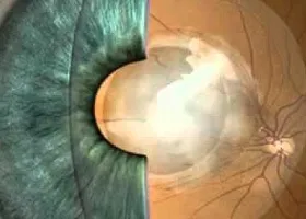 ІАГ-лазерна капсулотомія - офтальмологічний центр ophthalmica (провідний офтальмологічний центр Салонік) ІАГ-лазерна капсулотомія - офтальмологічний центр ophthalmica