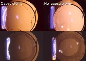ІАГ-лазерна капсулотомія - офтальмологічний центр ophthalmica (офтальмологи салоніки) ІАГ-лазерна капсулотомія - офтальмологічний центр ophthalmica