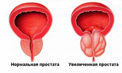 Гомеопатія для лікування простатиту у чоловіків (простатиту) Гомеопатія для лікування простатиту у чоловіків