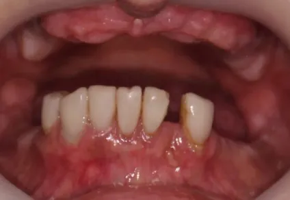 Імпланти з швеции - ціна, фото, відгуки (імпланти) Імпланти з швеции - ціна, фото, відгуки
