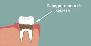 Пародонтальний (ясенної) кишеню кюретаж і лікування ясен між зубами (фото) (кишеню) Пародонтальний (ясенної) кишеню кюретаж і лікування ясен між зубами (фото)