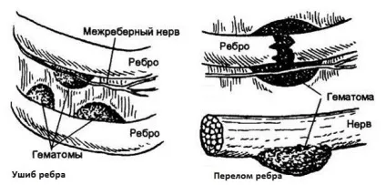 Перелом ребра, симптоми і лікування, скільки зростається, як спати, як лягає і вставати (скільки) Перелом ребра, симптоми і лікування, скільки зростається, як спати, як лягає і вставати