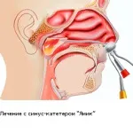 ЯМІК процедура при гаймориті, відгуки про лікування (процедура) ЯМІК процедура при гаймориті, відгуки про лікування