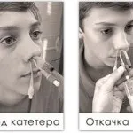 ЯМІК процедура при гаймориті, відгуки про лікування (гаймориті) ЯМІК процедура при гаймориті, відгуки про лікування