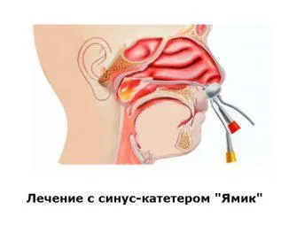 ЯМІК процедура при гаймориті або прокол, метод, сфеноїдиті, катетером (процедура) ЯМІК процедура при гаймориті або прокол, метод, сфеноїдиті, катетером