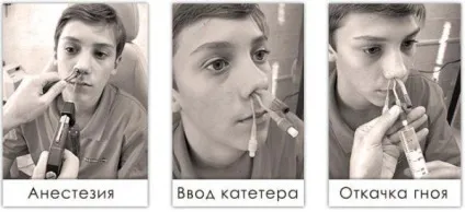 ЯМІК процедура при гаймориті або прокол, метод, сфеноїдиті, катетером (ЯМІК) ЯМІК процедура при гаймориті або прокол, метод, сфеноїдиті, катетером