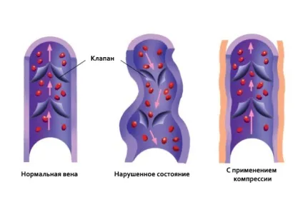 Навіщо потрібна компресійна одяг для спорту, переваги та ефект від спортивної компресійної (потрібна) Навіщо потрібна компресійна одяг для спорту, переваги та ефект від спортивної компресійної