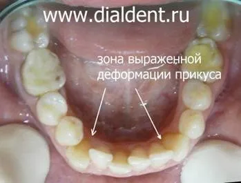 Виправлення кривих зубів (криві зуби) Виправлення кривих зубів