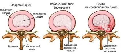 Йога при грижі хребта