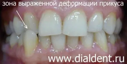 Виправлення кривих зубів (зубів) Виправлення кривих зубів