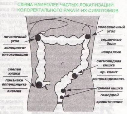 Дослідження показують, що молоді пацієнти мають більш високий ризик розвитку колоректального