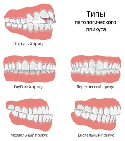 Виправлення прикусу зубів в Москві, ціни і вартість, методи і види виправлення, коментарі та фото, (прикусу) Виправлення прикусу зубів в Москві, ціни і вартість, методи і види виправлення, коментарі та фото,
