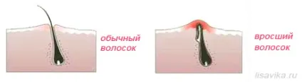 Як боротися з вросшими волоссям (боротися) Як боротися з вросшими волоссям