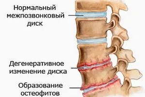Які зміни можна побачити на рентгені при остеохондрозі (рентгені) Які зміни можна побачити на рентгені при остеохондрозі