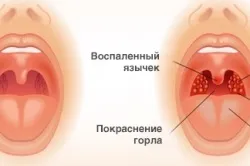 Як лікувати ангіну способи і профілактика (лікувати) Як лікувати ангіну способи і профілактика
