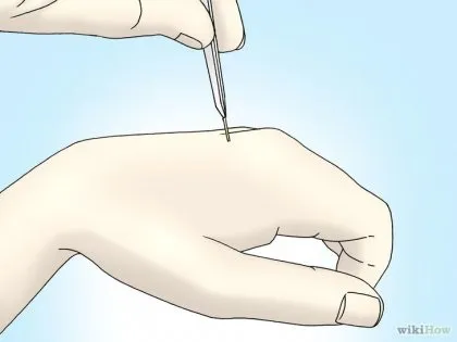 Як витягти кактусові голки (howto) Як витягти кактусові голки