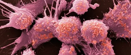 Як лікувати метастази хірургія, хіміотерапія, опромінення і трави (скільки можна лікувати метастази) Як лікувати метастази хірургія, хіміотерапія, опромінення і трави
