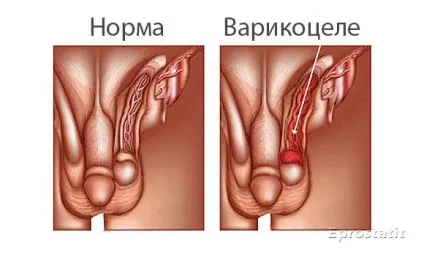 Як лікувати варикоцеле - ефективні методи без операції (лікувати) Як лікувати варикоцеле - ефективні методи без операції