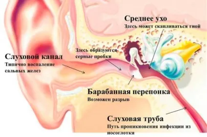 Як позбутися самостійно від пробки в вухах в домашніх умовах (сірчаної) Як позбутися самостійно від пробки в вухах в домашніх умовах
