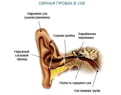Як позбутися самостійно від пробки в вухах в домашніх умовах (самому) Як позбутися самостійно від пробки в вухах в домашніх умовах