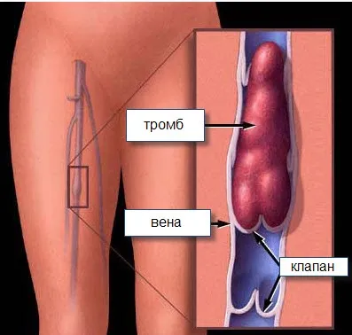 Як відрізнити тромбофлебіт від тромбозу, варикозної хвороби, флебіту як проводиться лікування патологій (тромбозу) Як відрізнити тромбофлебіт від тромбозу, варикозної хвороби, флебіту як проводиться лікування патологій