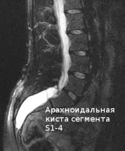 Як проявляється арахноідальной кіста хребта (проявляється) Як проявляється арахноідальной кіста хребта